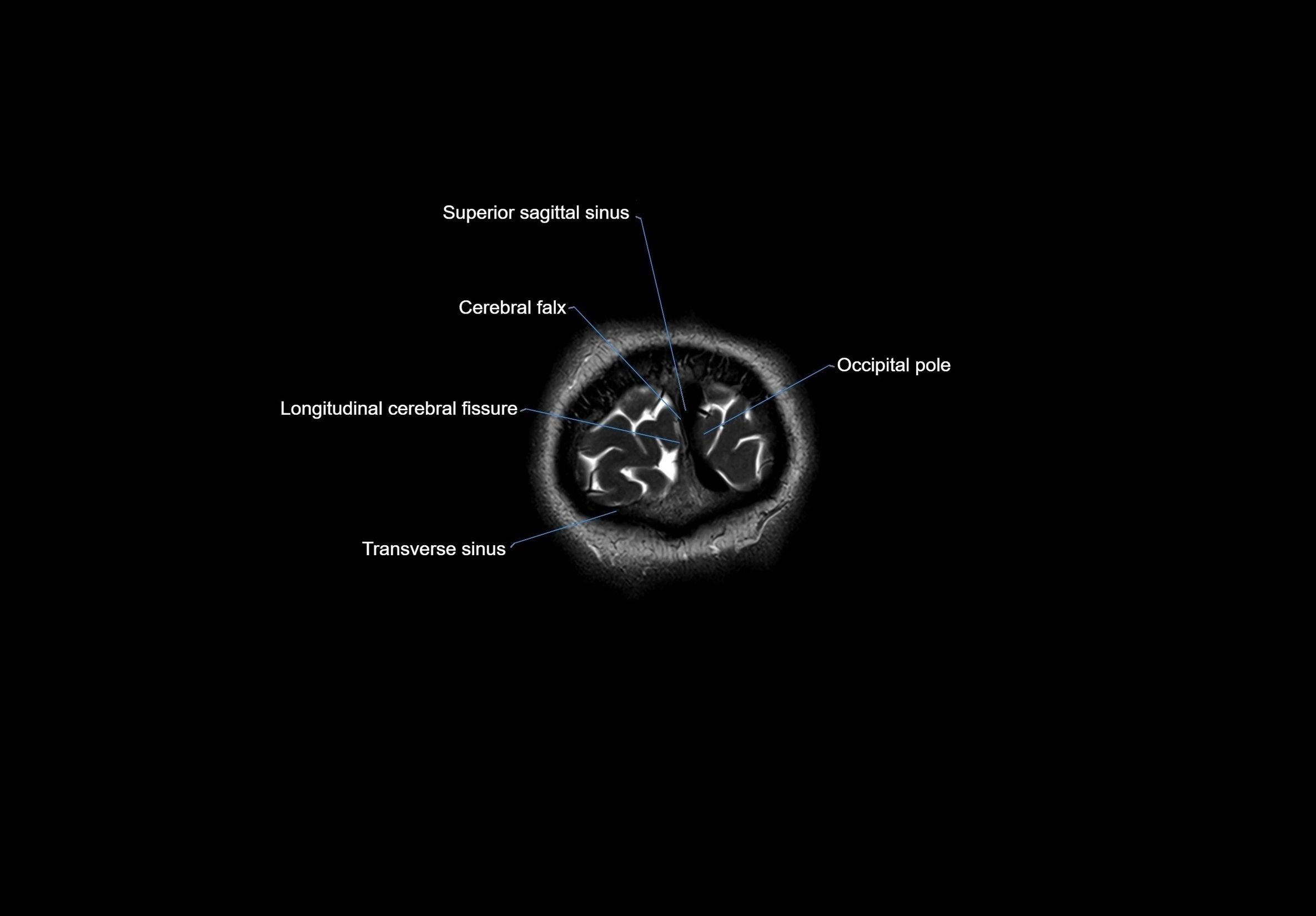 MRI Brain coronal cross sectional labelled anatomy 3T image  -img-00001-00073.webp